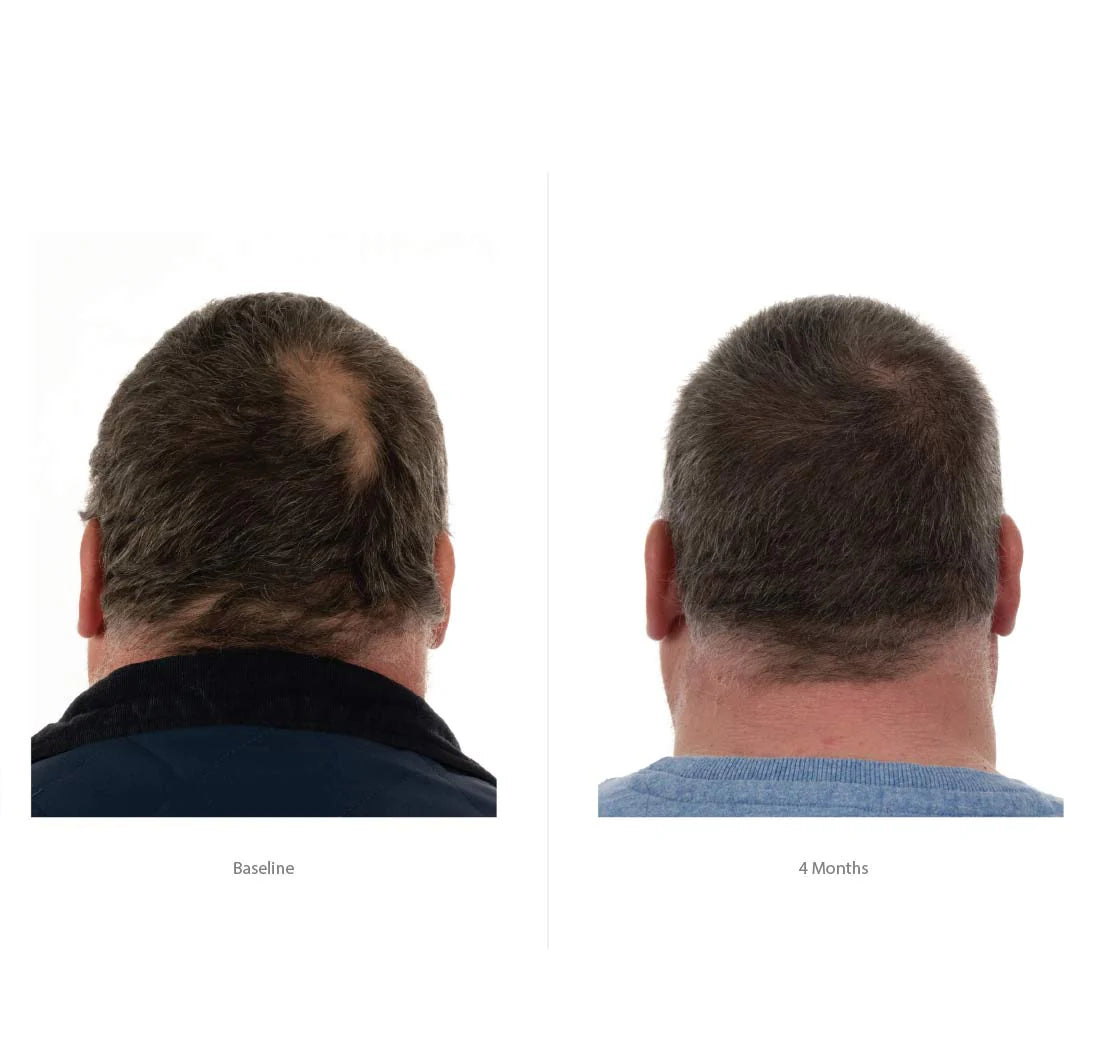 FOLIGAIN Triple Action Conditioner Trioxidil 2% Homme Après-Shampoing Anti-Chute Cheveux Densité Volume Croissance Capillaire